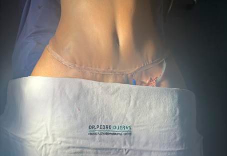 abdominoplastia